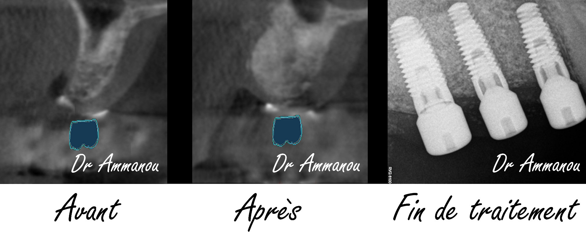 Greffes osseuses Le Perreux sur Marne (94170) Dr Terence Ammanou Dentiste au Perreux sur Marne